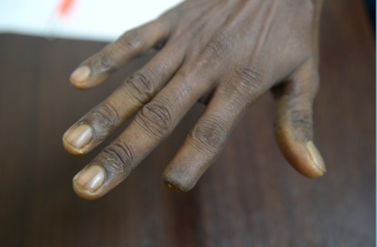 Worker index finger crushed but was given only 1 day medical leave