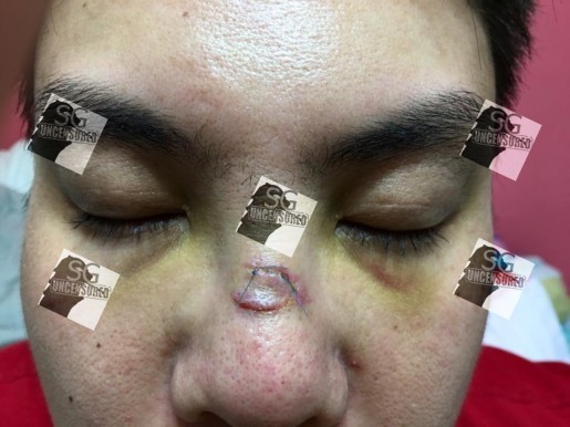 Singapore man got punched by ang mo till nose fractured was also arrested and now face possible charges