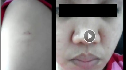 FILIPINO DOMESTIC HELPER ABUSED! BITE BY SINGAPORE LADY BOSS!(VIDEO)