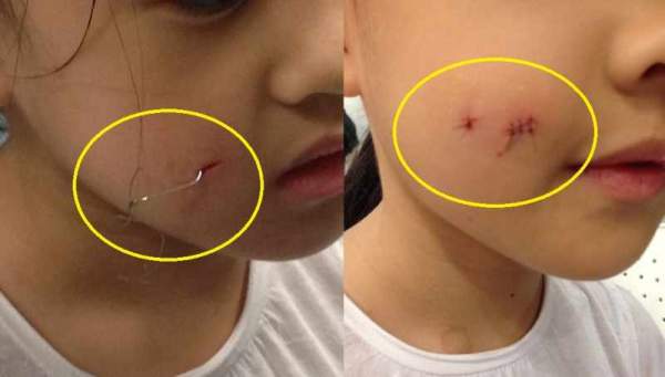 BEWARE! GIRL GOT FISHING HOOK IN HER FACE @ BISHAN AFTER OTHER KIDS ‘PLAY FISHING’