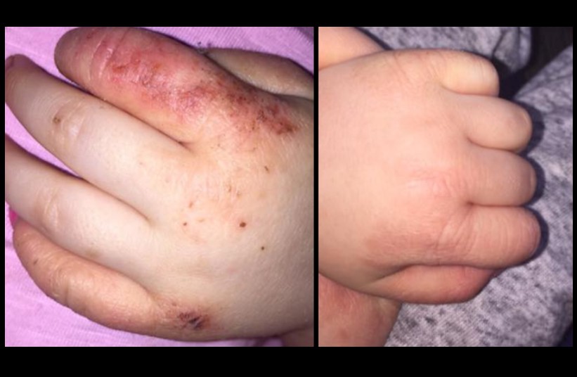 MOTHER CLAIMS MIRACLE CREAM FOR ECZEMA (Less than $7)