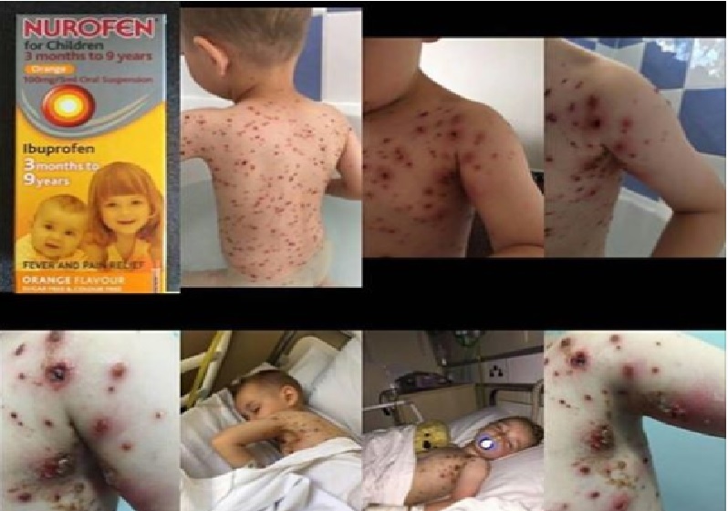 PARENTS TAKE NOTE! DO NOT GIVE THIS MEDICINE TO YOUR CHILD WITH CHICKEN POX!!!