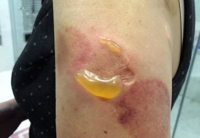 TCM PHYSICIAN BURNED PATIENT. FACING LEGAL ACTION FROM PATIENT.