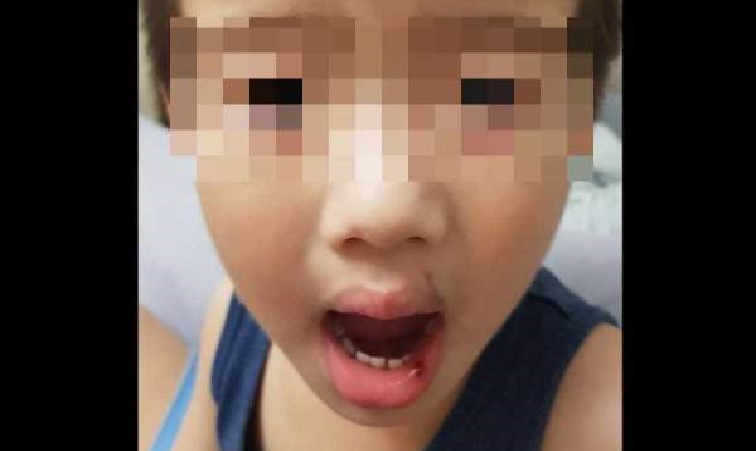 CHILDCARE FAILED TO EXPLAIN TO MOTHER HOW HER SON GOT CUT