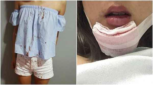 PASSENGER BLEEDING, GRAB DRIVER ONLY BUSY TAKE PHOTOS OF ACCIDENT