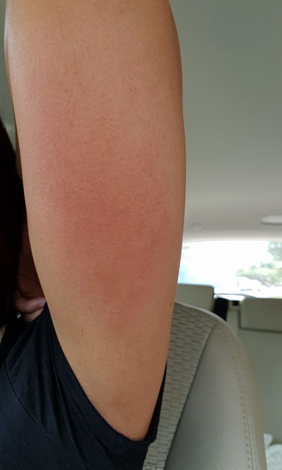 NETIZEN CLAIMS SHE DEVELOP RED RASHES LIKE ITCH AFTER TAKING BUDGET AIRLINES!