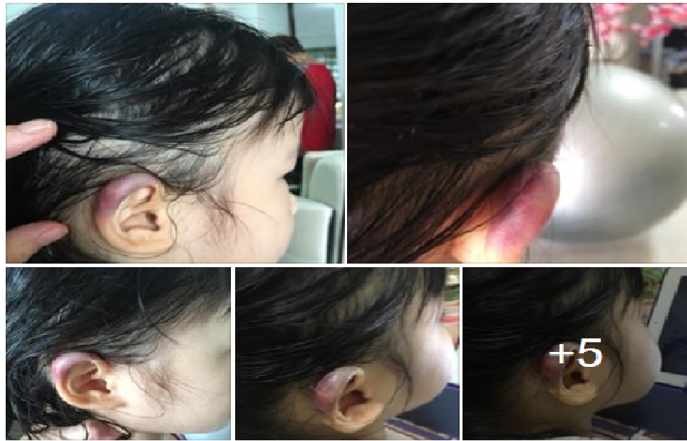 3 Y.O GIRL ABUSED BY PRESCHOOL TEACHER. SUSPECTED TEACHER STILL ALLOWED TO WORK