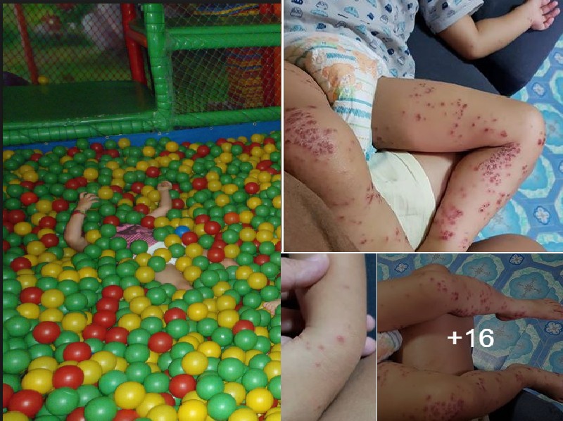 KID INFECTED WITH HAND FOOT MOUTH DISEASE AFTER PLAYING IN BALL PIT