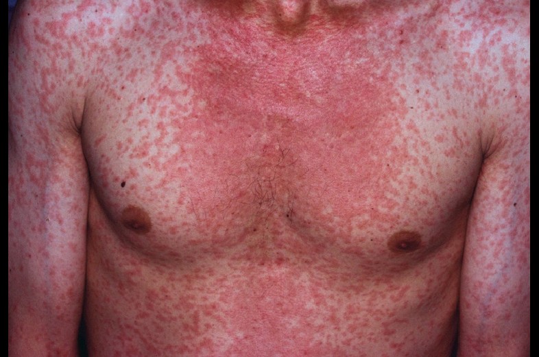 MEASLES OUTBREAK IN THAILAND! BE ADVISED!