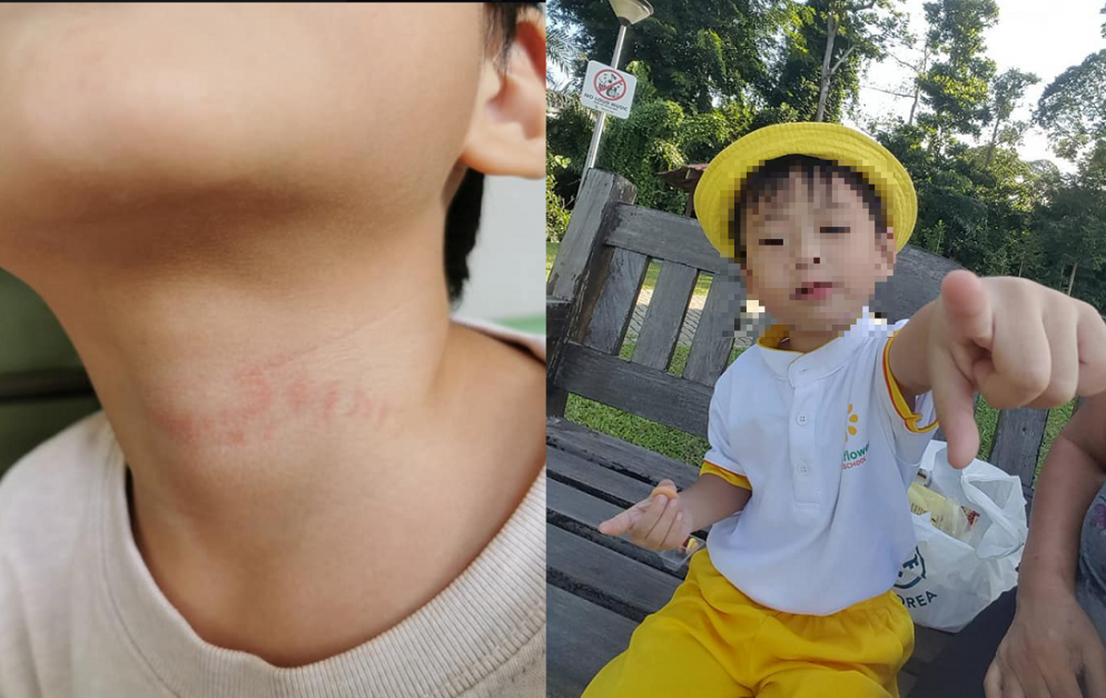 MOTHER CLAIMS CHILD ABUSE AT CHILDCARE. ROPE MARK ON NECK