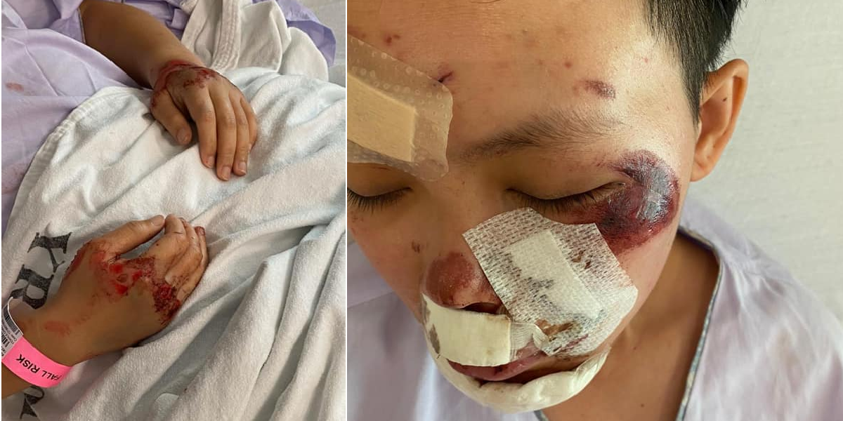 HIT AND RUN ACCIDENT ON PIE, FEMALE RIDER SUFFERS MULTIPLE INJURIES