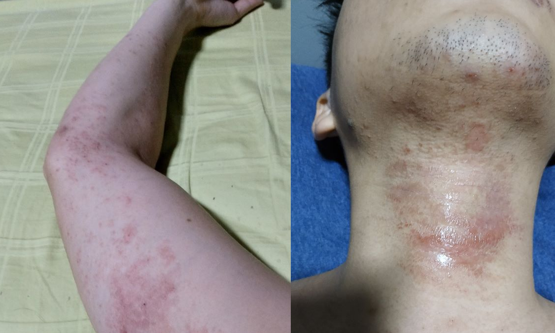 MAN SUFFERS SKIN DISEASE AFTER EXPOSED TO TOXIC MATERIAL AT WORK