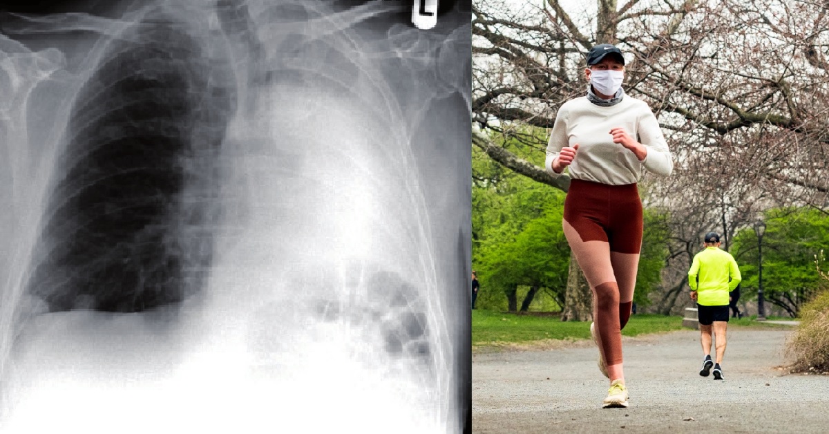 JOGGER’S LUNG COLLAPSES AFTER RUNNING WITH FACE MASK