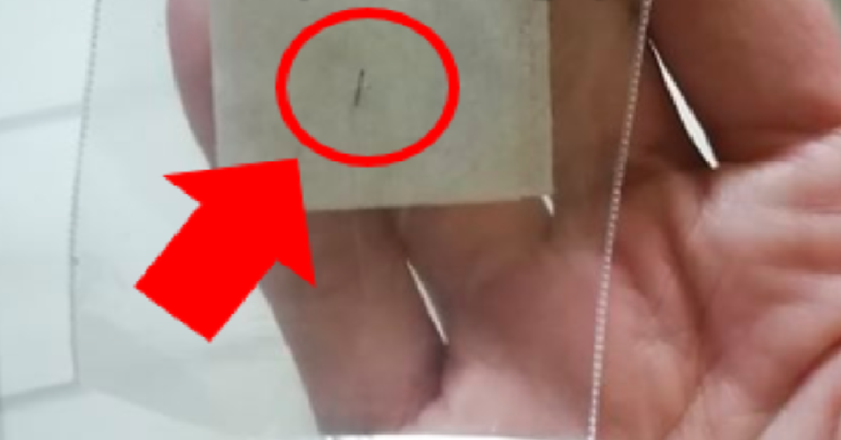 Little Splinter JURONG CLINIC CHARGED $180 TO REMOVE TINY SPLINTER