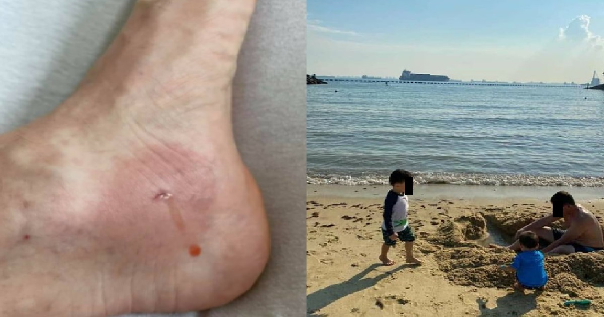 MAN STEPS ON STINGRAY AT TANJONG BEACH, KENA STUNG AND SENT TO HOSPITAL