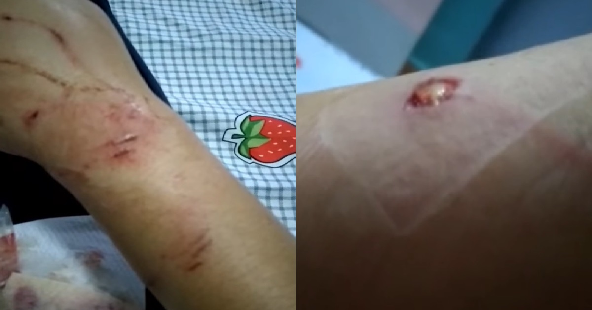 MAID KENA BITTEN BY DOG UNTIL HAND BLEED, EMPLOYER ALLEGEDLY DELAY TREATMENT FOR 2 DAYS