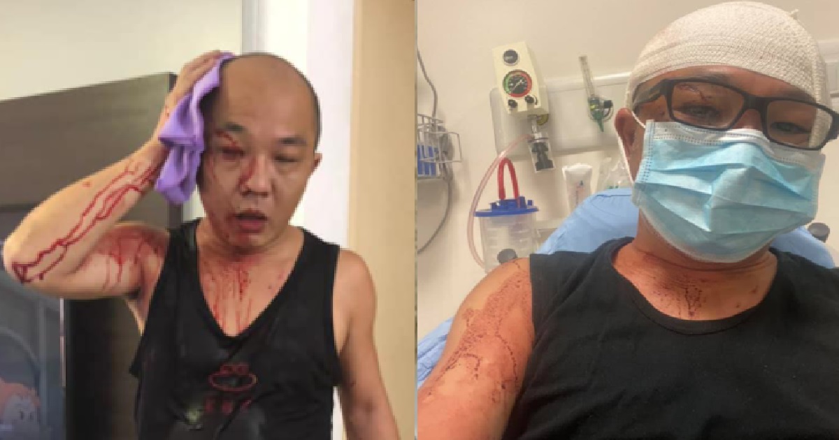 MAN ALLEGEDLY ATTACKED BY NEIGHBOUR, HIT ON HEAD WITH BICYCLE CHAIN