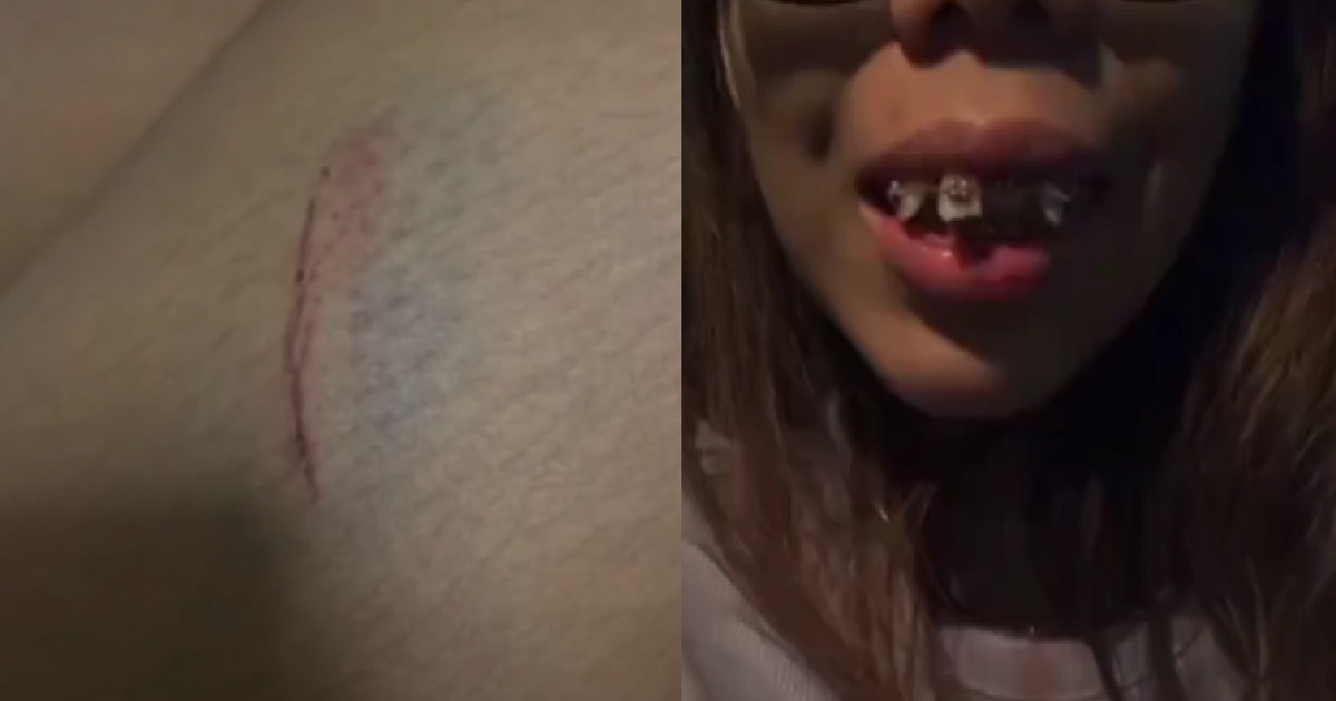 GIRL ALLEGEDLY BEATEN UP BY BF, HAD TO GO FOR SURGERY TO REMOVE TOOTH