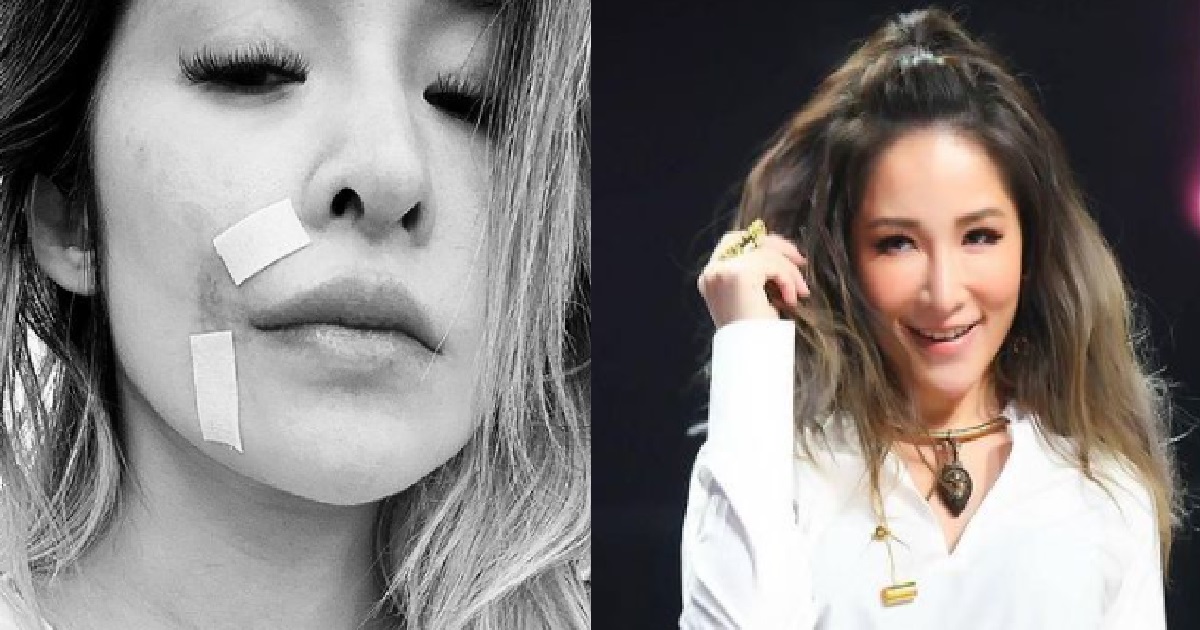 POP STAR ELVA HSIAO BADLY SCARRED AFTER BITTEN BY ADOPTED DOG