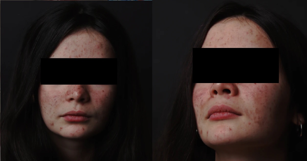 GIRL CONFESS FEELINGS TO CRUSH BUT SCARED HE REJECT HER BECAUSE SHE GOT PIMPLES