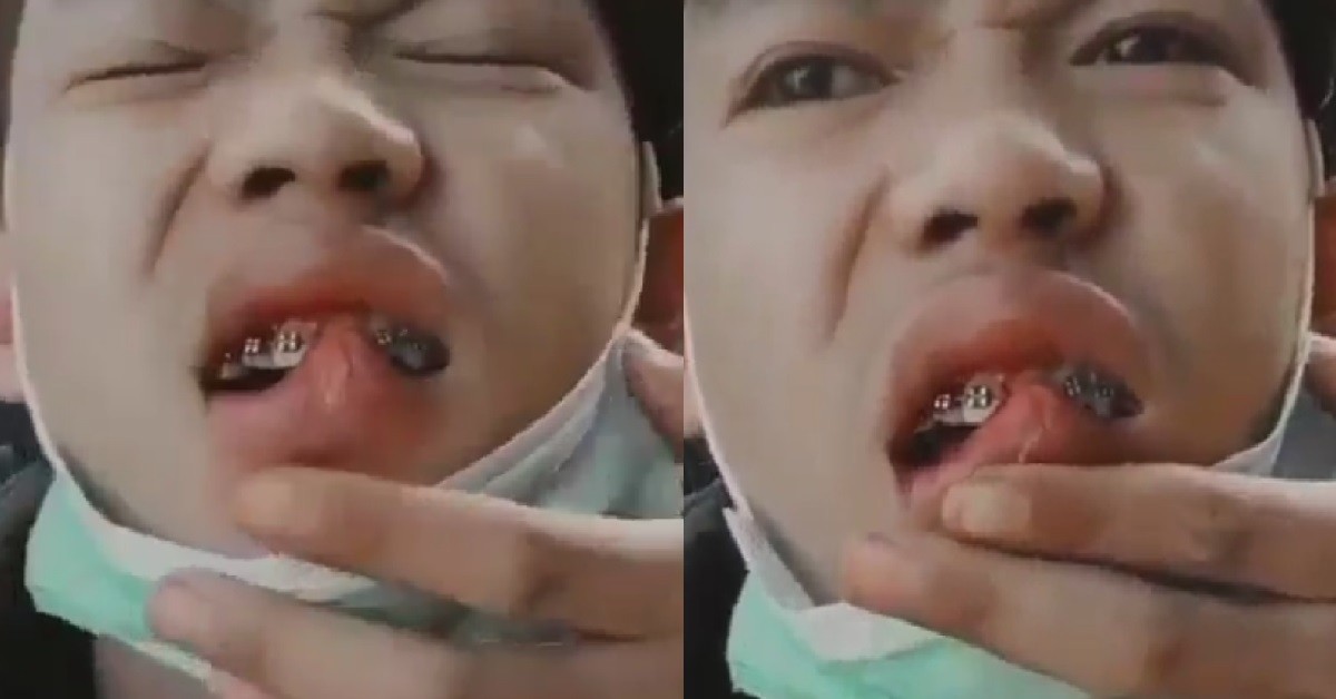 GUY’S LIP STUCK INSIDE HIS BRACES, PANICS AND STARTS CRYING