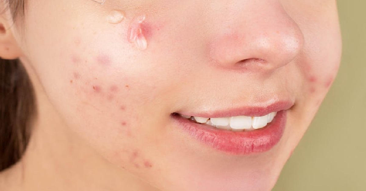 GIRL SICK OF OTHERS COMMENTING ON HER ACNE & ASKING “WHY YOUR FACE LIDDAT”