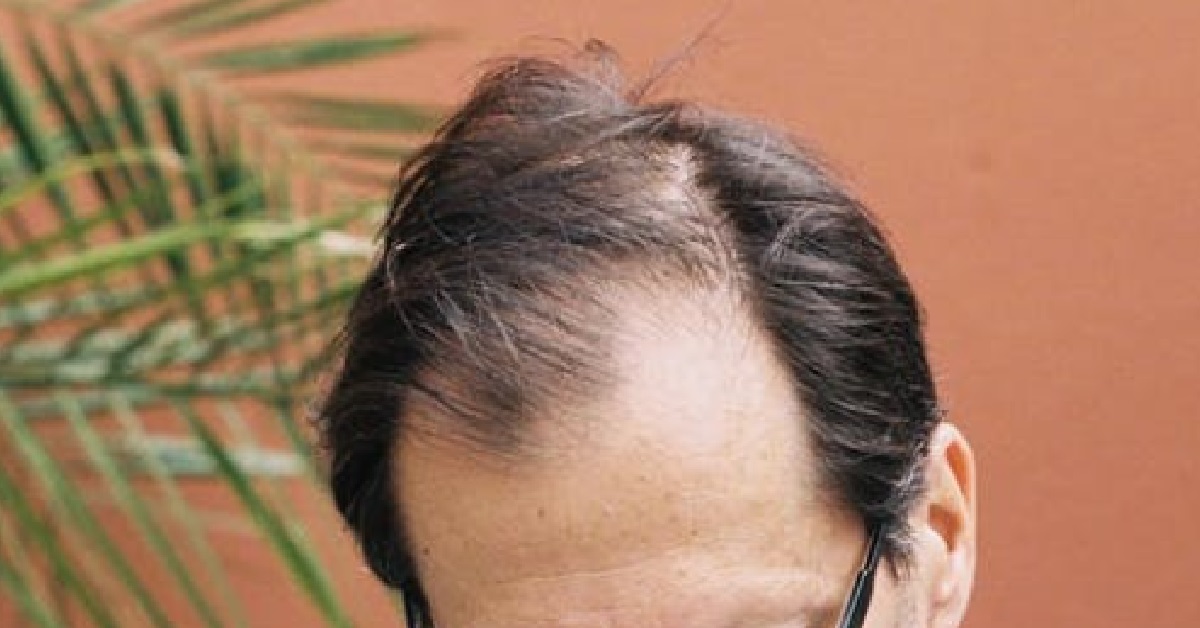 GUY ONLY IN HIS 20S BUT STARTS BALDING, GETS CALLED “UNCLE” BY PEOPLE HIS OWN AGE