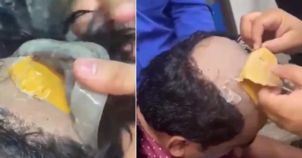 MAN CAUGHT SMUGGLING GOLD ON BALD HEAD AND INSIDE HIS RECTUM