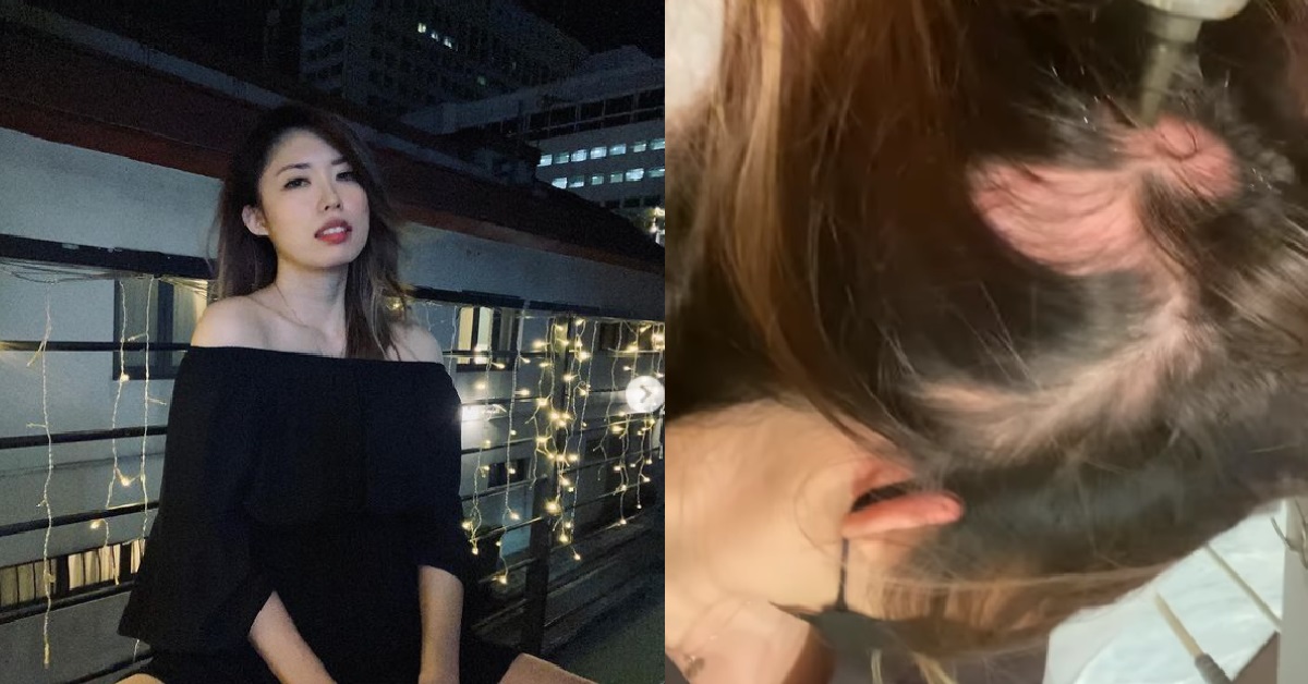 NOC’S NINA DIAGNOSED WITH ALOPECIA, WHICH CAUSES HAIR LOSS