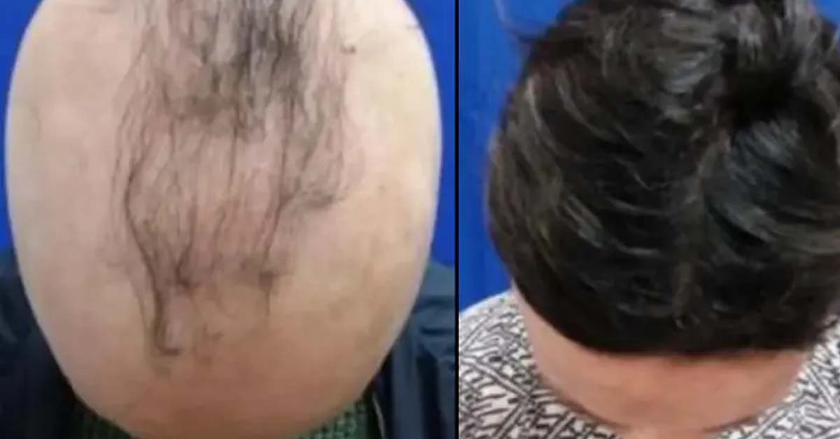 US SCIENTIST DISCOVERS NEW HAIR LOSS DRUG, HOPE IS NEAR