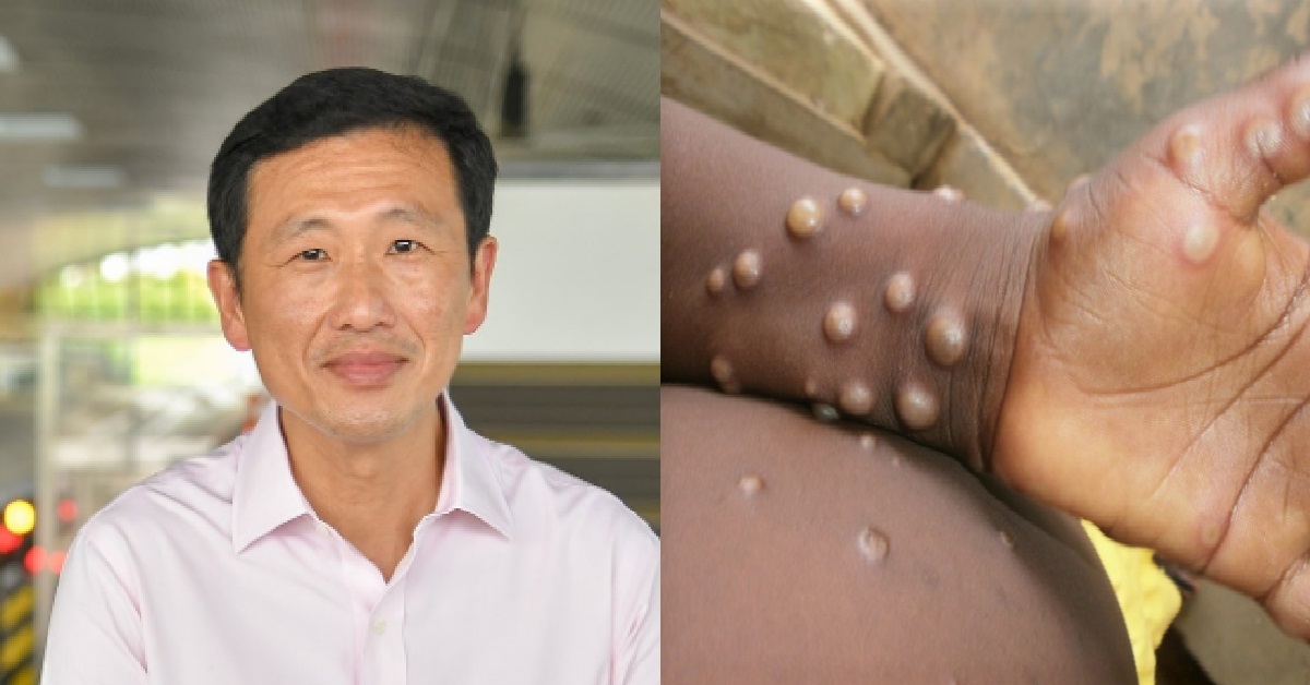 ONG YE KUNG – DON’T BE SURPRISED IF MONKEYPOX CASES DETECTED IN S’PORE