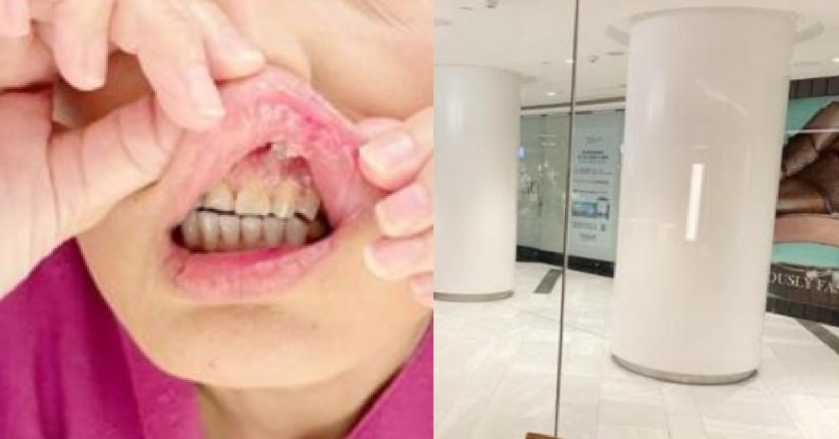 GLASS WALL CLEANED UNTIL CANNOT SEE, DINER WALKED FACE-FIRST INTO IT