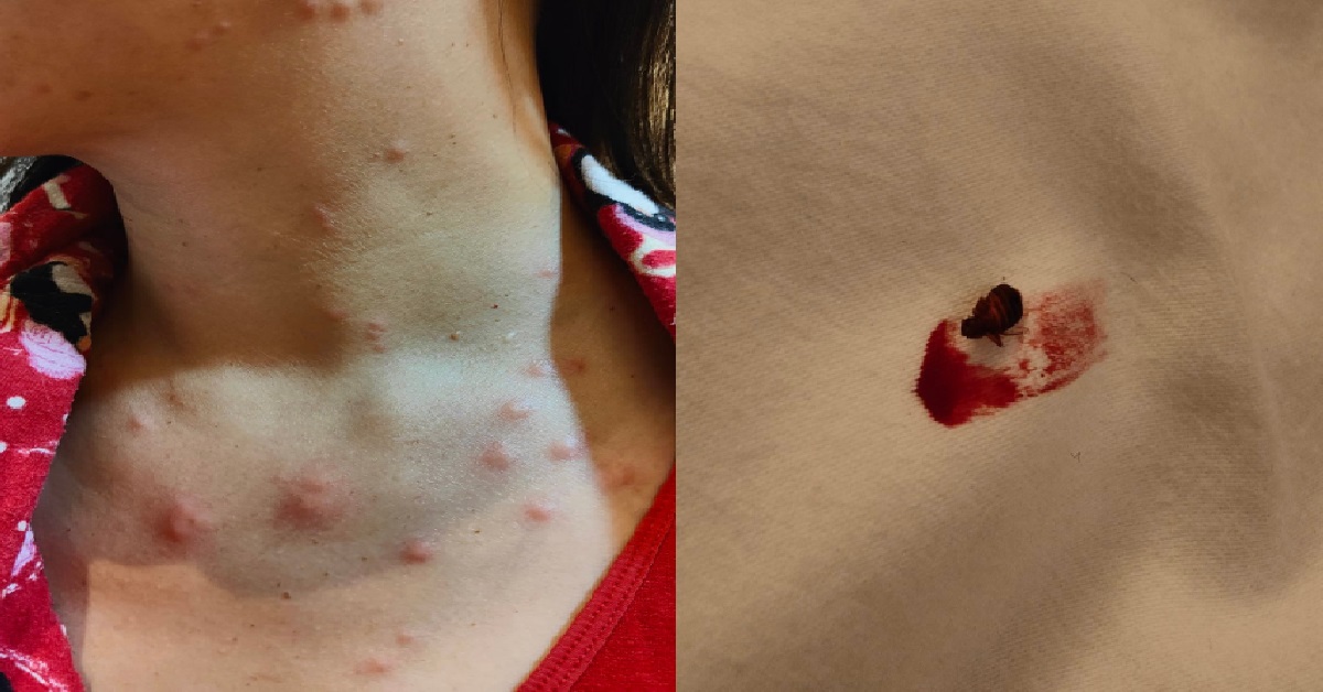 MAN STAYED AT JALAN BESAR HOTEL & BITTEN BY BED BUGS, HOTEL SAYS HE BROUGHT IT IN