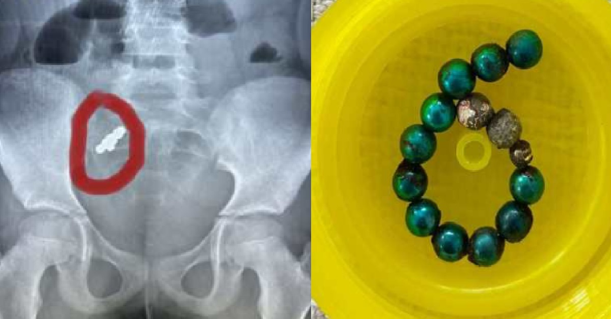 9 Y.O S’PORE GIRL SWALLOWED MAGNETIC BALLS, INTESTINES PUNCTURED