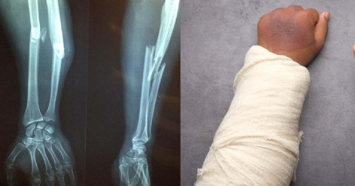 GUY BROKE HIS ARM, PARENTS TOLD HIM: “DON’T BE DRAMATIC”