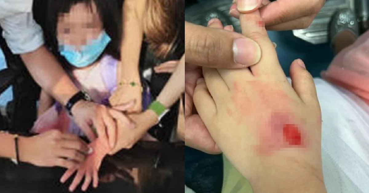 5 Y.O GIRL HAD SKIN TORN OFF HER HAND IN ESCALATOR ACCIDENT @ ASIA SQUARE