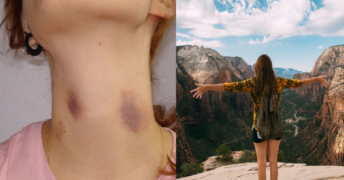 GUY’S GF RETURNED FROM HOLIDAY WITH A LOVE BITE ON HER NECK