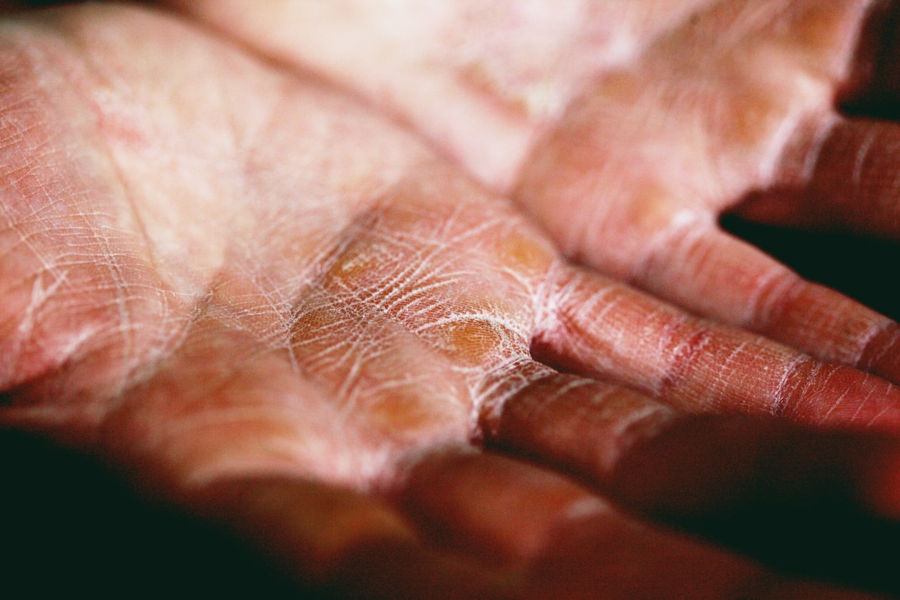 WIFE DEVELOPS ECZEMA AFTER CHILDBIRTH AFFECTING S LIFE