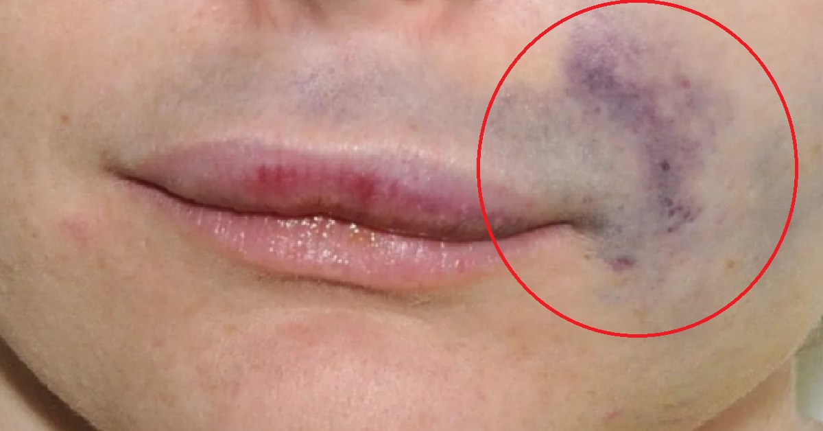 WOMAN’S DENTAL SURGERY WENT WRONG, DOCTOR LAUGHED AT HER & SAID “NOT MY PROBLEM”