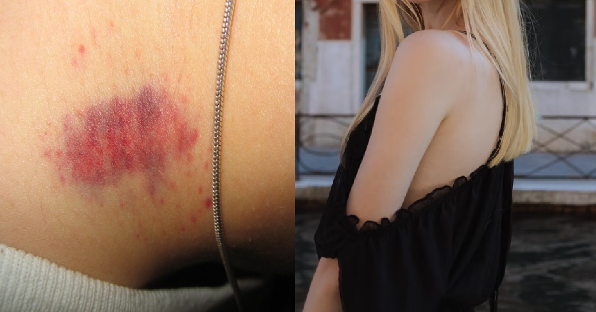 GIRL’S BF GIVES HER LOVE-BITES SO THAT SHE CAN’T WEAR REVEALING CLOTHES OUT