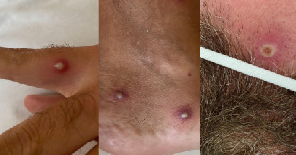 MAN ONE-SHOT KENA COVID, MONKEYPOX & HIV AT THE SAME TIME, “SIBEI SUAY”