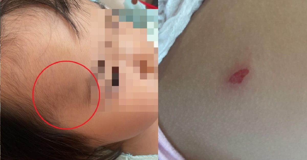 TODDLER CAME HOME WITH BRUISES, PRESCHOOL ACCUSES CHILD OF SCRATCHING TEACHER