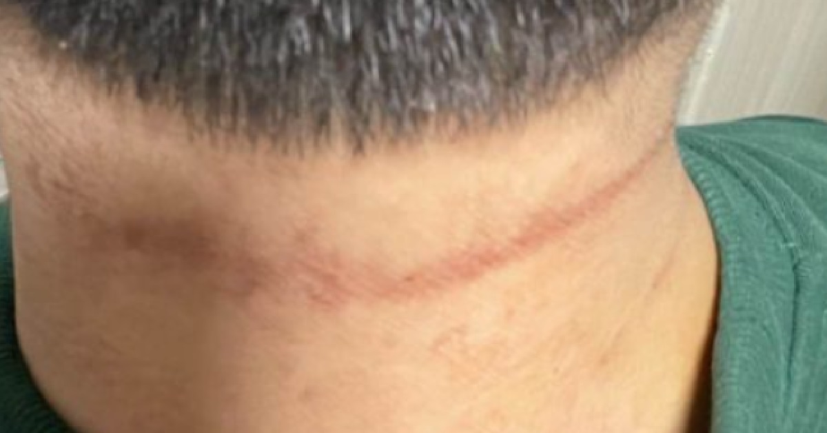MAN ALLEGEDLY SUFFERED CHEMICAL BURNS AFTER APPLYING YOKO YOKO ON HIS NECK