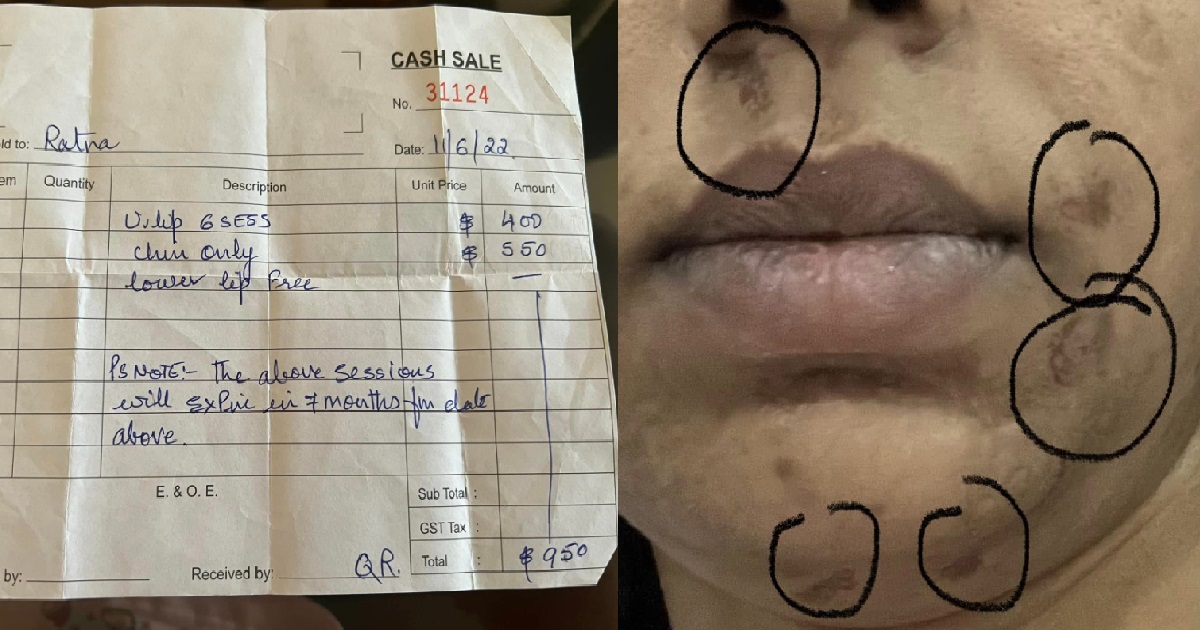 MAN DID BEAUTY TREATMENT TO STOP FACIAL HAIR GROWTH, GETS BURNT ON THE FACE