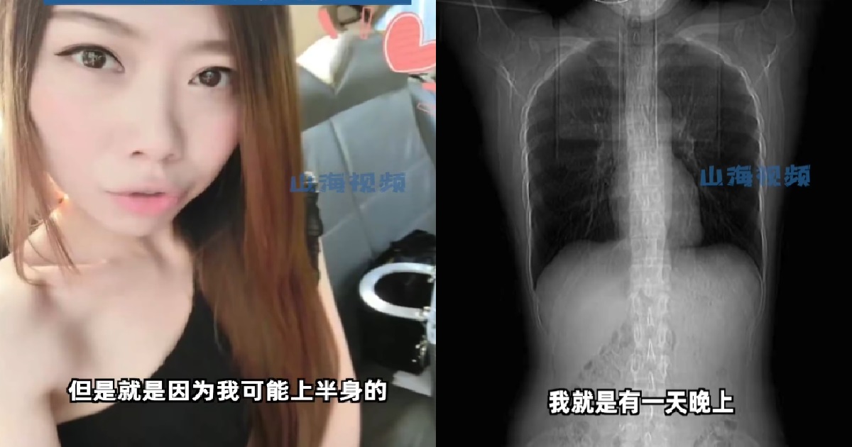 WOMAN ATE SPICY FOOD, ENDS UP BREAKING 4 OF HER RIBS AFTER COUGHING