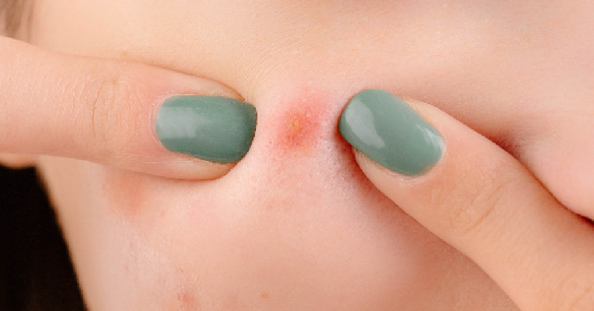 WIFE OBSESSED WITH POPPING HUSBAND’S PIMPLES, TELLS HIM TO “TAKE IT LIKE A MAN”