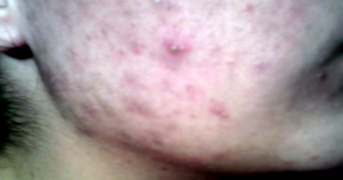 FRIEND’S HUSBAND TOLD HER SHE WAS HOT “DESPITE THE OBVIOUS ACNE”, OFFENDS HER