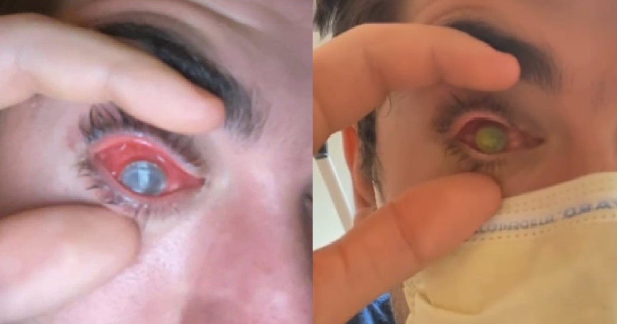 GUY FELL ASLEEP WITH CONTACT LENSES ON, LOSES HIS EYE TO FLESH-EATING BACTERIA