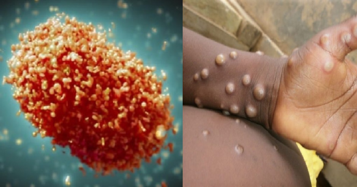 S’PORE TO CALL MONKEYPOX “MPOX” INSTEAD, 2 LOCAL CASES OVER THE LAST 4 MONTHS
