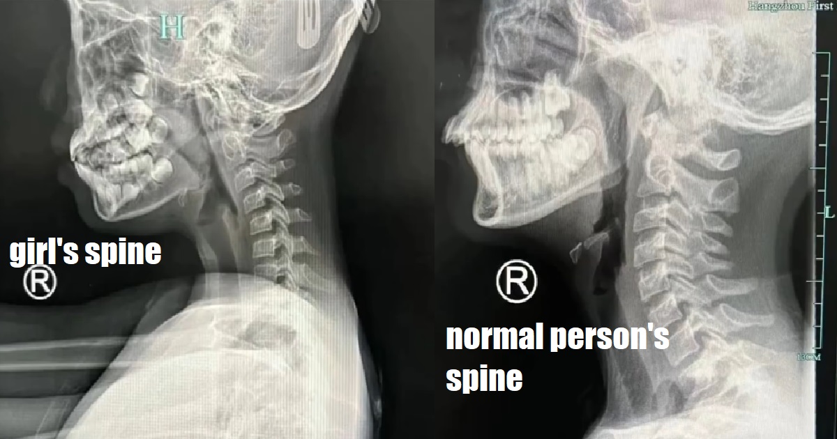 9 Y.O GIRL USED PHONE FOR HOURS UNTIL SPINE NO LONGER CURVES NATURALLY